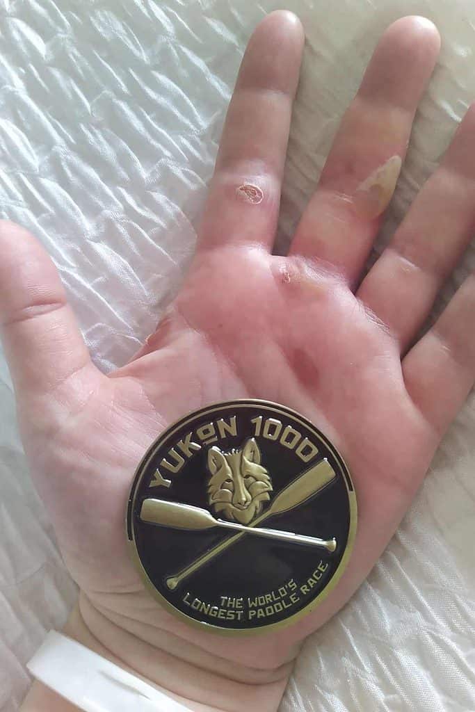 A woman's hand with blisters, holding a medal